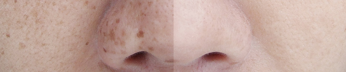 tratamientos lecanart